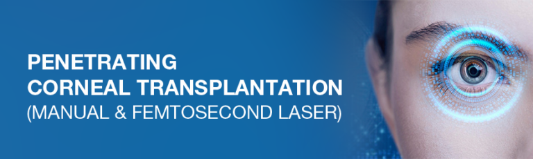 Cornea Transplants